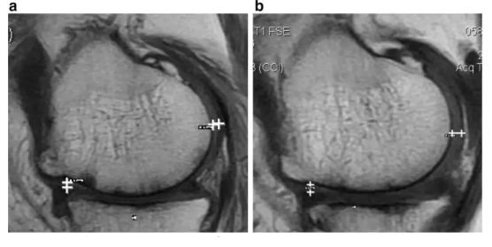 关节内注射干细胞治疗骨关节炎5例临床研究